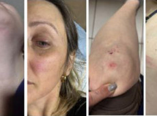As marcas da violência estão por várias partes do corpo da mãe