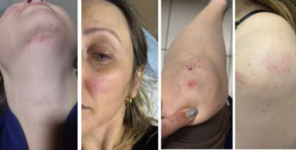 As marcas da violência estão por várias partes do corpo da mãe