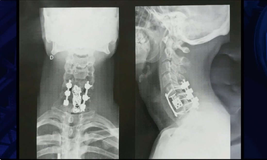 A radiografia ap&oacute;s a cirurgia e o in&iacute;cio do processo de recupera&ccedil;&atilde;o de Bruno